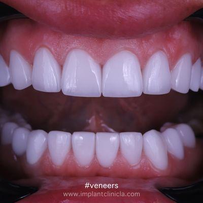 Full Mouth Porcelain Veneers