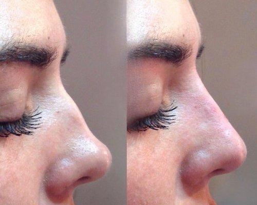 Non-Surgical Rhinoplasty