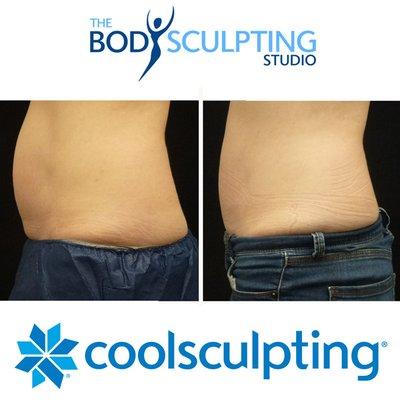 Get rid of your unwanted diet and exercise resistant fat with CoolSculpting at The Body Sculpting Studio.