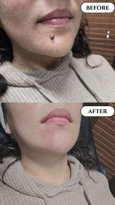 Before and after mole removal