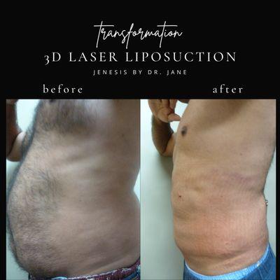 3D Laser Liposuction  with local anesthesia