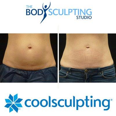 Get rid of your unwanted diet and exercise resistant fat with CoolSculpting at The Body Sculpting Studio.