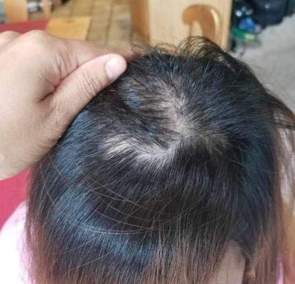 My daughter has problems with hair lost