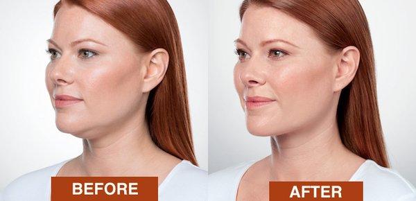 Lose the double chin with Kybella injections to dissolve fat at Newport Medical & Wellness Center.