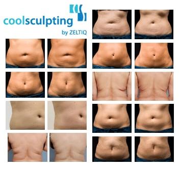 Coolsculpt.