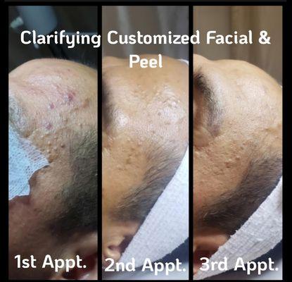 Men's customized clarifying & scar reduction facial with PCA Peel