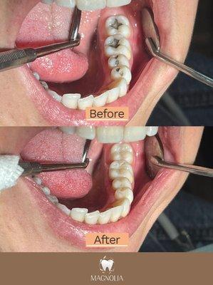 Amalgam to Composite Bonding Restorations