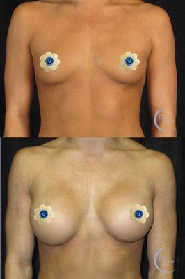 Breast Augmentation