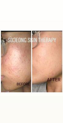 Severe acne Treatment before&after