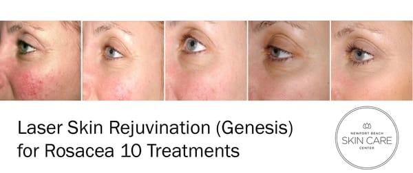 Laser Skin Rejuvenation (Genesis) for rosacea, enlarged pores, fine lines, skin texture