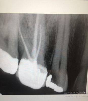 Before X-ray tooth #4, needs Root canal, build-up, crown.