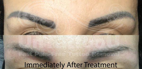 Some eyebrow ink can move very quickly to make room of new microblading sooner.