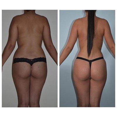 LIPOSUCTION AND FAT TRANSFER