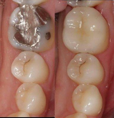 CEREC (teeth in a day) onlay before and after