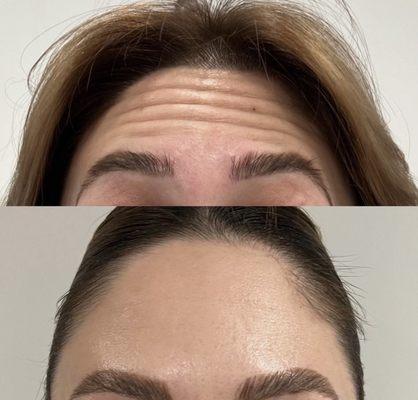 Botox results