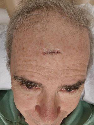 Basal Cell Cacinoma (BCC) completely removed using MOHS surgery