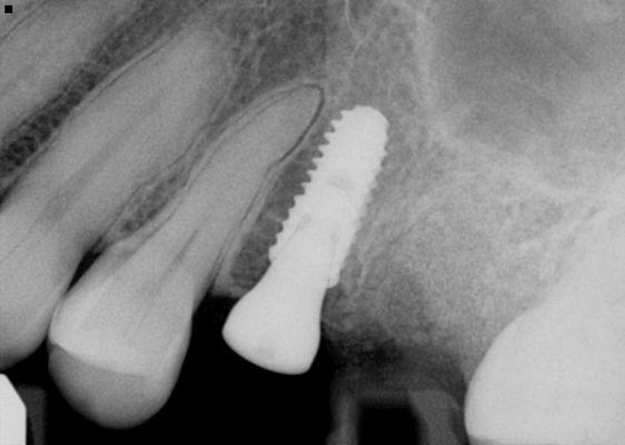 Impacts can keep the sinus floor up