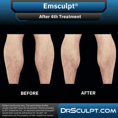 After 4th CoolSculpting treatment on calves