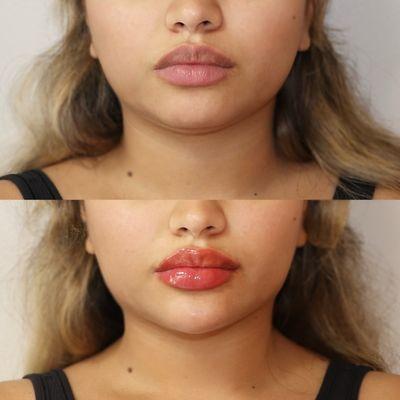 Facial Rejuvenation and balancing with dermal fillers - Chin, cheek, lips