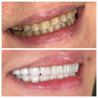 Before and after of a full mouth makeover.