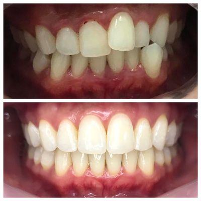 INVISALIGN before and after