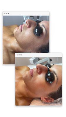 HydraFacial Before and After