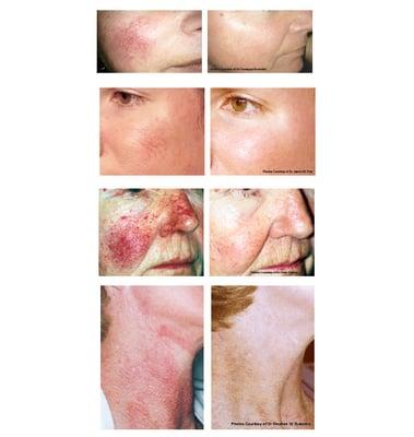 These are before and after photos of patients treated with the same laser carried at our spa. (courtesy of Vbeam Perfecta)