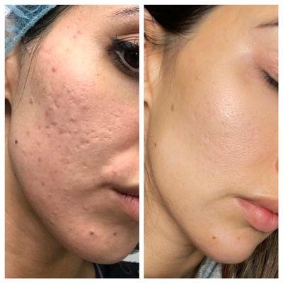 Microneedling with PRP injections combine with other treatments for acne scars