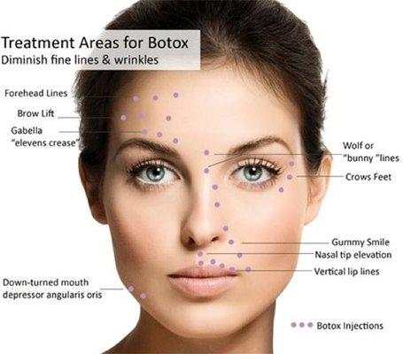 Temecula Botox Wrinkle Removal Face Neck Tightening Fillers Ultherapy