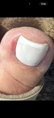 Toe nail