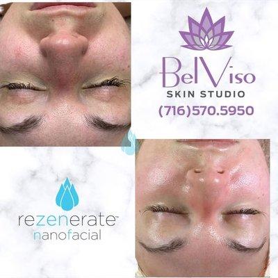 Have you heard of the Rezenerate Nano Facial? It's an A-MAZING treatment that delivers same-day results you can see and feel, with smoother,