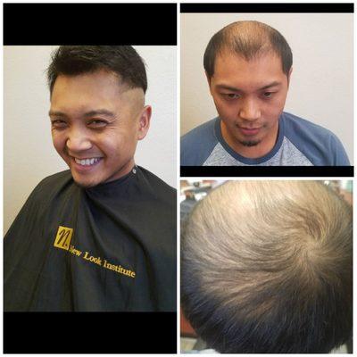 Custom hair replacement for men. Call for info and pricing - (408)279-4247.