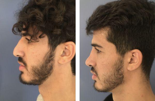 rhinoplasty before and after results Dr. Daniel Golshani