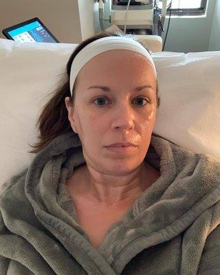 Before my 2nd treatment - glowing skin is from all the numbing cream before the Morpheus 8 treatment begins.