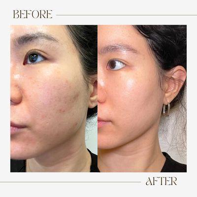 VIVACE microneedling RF before and after