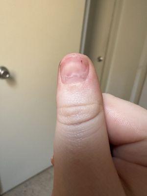 Broken nail