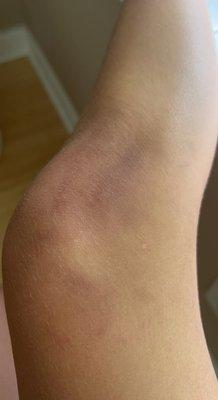 bruise from falling off the tube