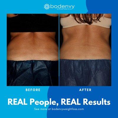 Bodenvy Coolsculpting Orlando