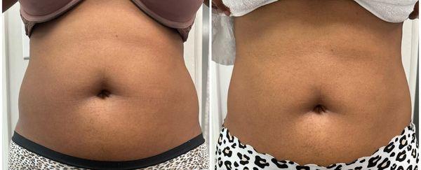 Multishape-Body Sculpting. Before and after one session