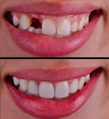 Smile Design Center of Westchester, before and after