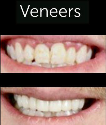 Don't hide your smile ! Change your smile with Veneers ! Call us for a consultation 7148356677!