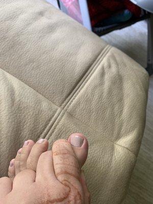 Toenail infection