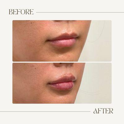 Lip Filler before and after