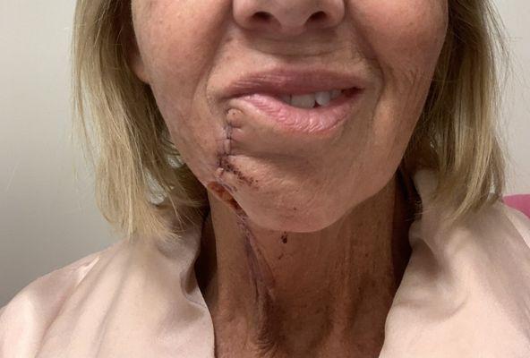 This is 2 days later, after plastic surgery A hole was left to heal