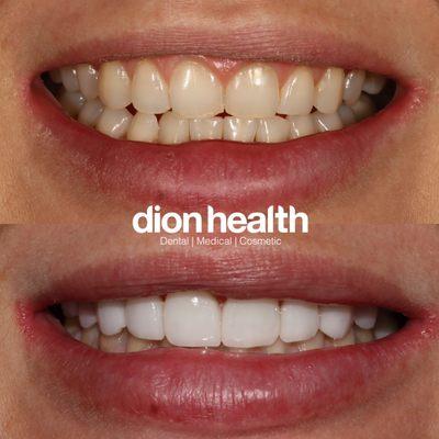 before and after of porcelain veneers