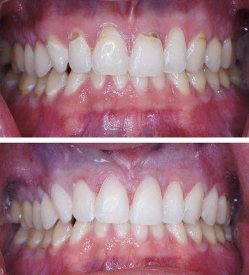 Decay corrected in one visit with dental composite bonding.