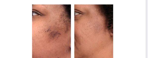 Our AdvaTx laser pigmentation treatment