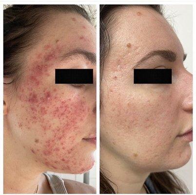 Morpheus8 Acne result