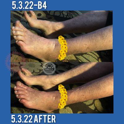 Photo#2, same day of the ankle lymphatic drainage, with the same size flowers to show you the measurements of the reduced swelling.