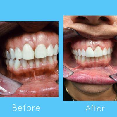 Before-After, Dr. Sherri Bluth used diode laser to even gum line, then inserted PERFECT porcelain veneers!